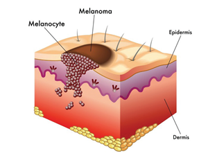 Mole - una formación natural que se puede quitar con la ayuda de las células de la piel Pro