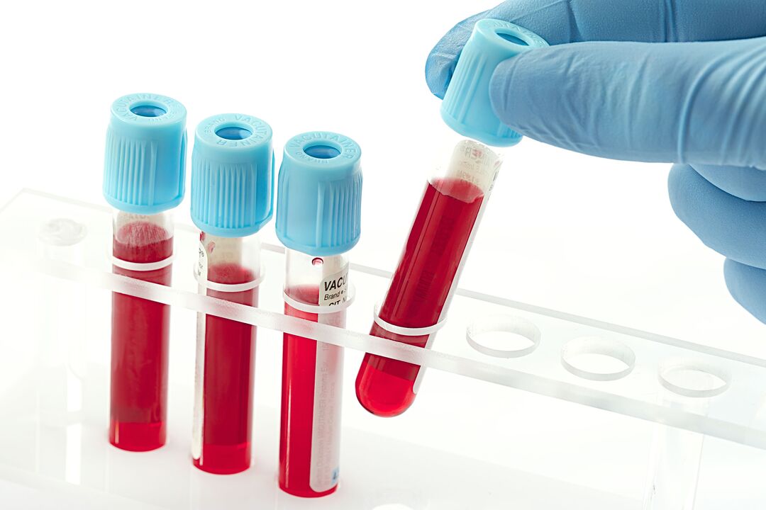 análisis de sangre para diagnosticar el virus del papiloma humano